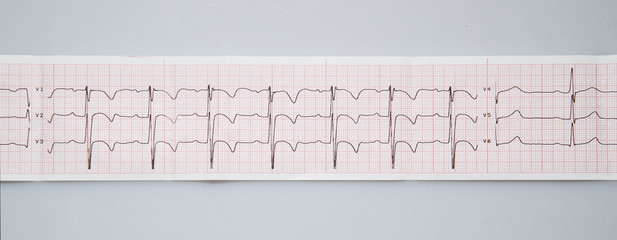 Medical research. Electrocardiogram. The normal result of electrocardiography in a 3-year-old child.