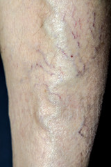 Varicose veins on the leg