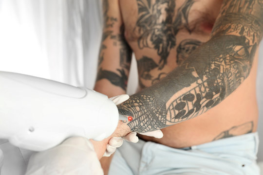 Man undergoing laser tattoo removal procedure in salon, closeup