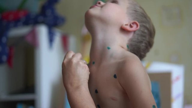 chicken pox in a little boy - a woman treats a child at home for chickenpox - handheld shoot