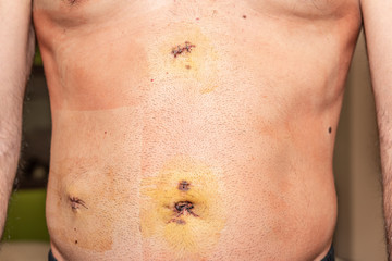 Fototapeta premium After surgery scars. Man's belly after laparoscopy. Metal staples. 