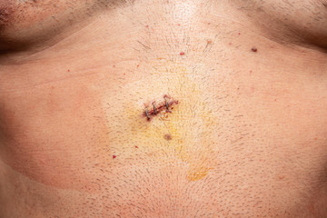 After surgery scars. Man's belly after laparoscopy. Metal staples.	