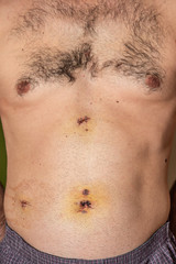 Naklejka premium After surgery scars. Man's belly after laparoscopy. Metal staples. 