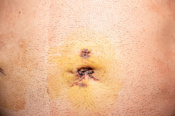 Fototapeta premium After surgery scars. Man's belly after laparoscopy. Metal staples.