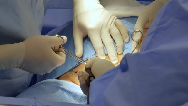 Close-up of doctors performing a surgical operation on a patient's abdomen with visible incision and blood