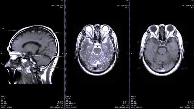 MRI of the brain sagittal and Coronal plane comparison. Medical technology concept.