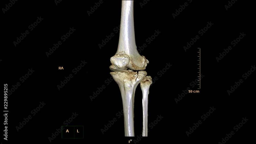 Poster ct scan of right knee 3d rendering image rotating on the screen . medical technology concept.