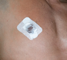 Bactericidal adhesive tape on the male nipple. Dressing after surgery on the nipple areola.