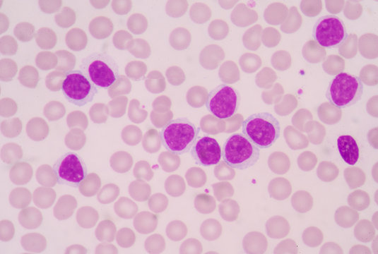 cancer in which the bone marrow makes abnormal myeloblasts a type of white blood cell.