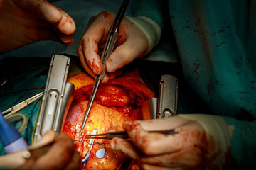 A surgeon performs coronary artery bypass grafting open heart surgery.