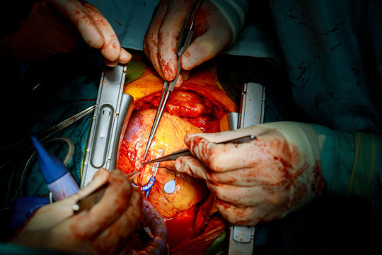 Heart surgery. Open heart surgery suture greater saphenous vein