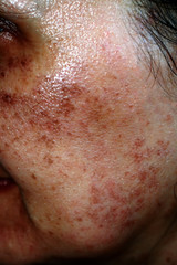 Fototapeta premium Pigmented spots on the face. Pigmentation on cheeks