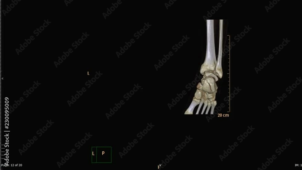 Poster ct scan of left ankle 3d rendering image rotating on monitor in ct scanner room .