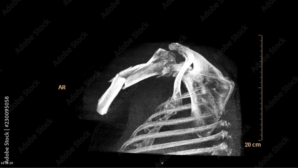 Poster ct scan 3d rendering image of left shoulder use maximum intensity projection technique (mip) show fr