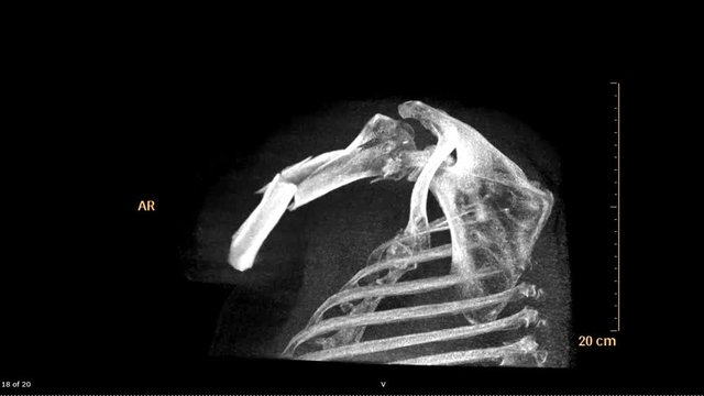 CT scan 3D rendering image of Left shoulder use  Maximum intensity projection technique (MIP) show fracture shoulder transparency .