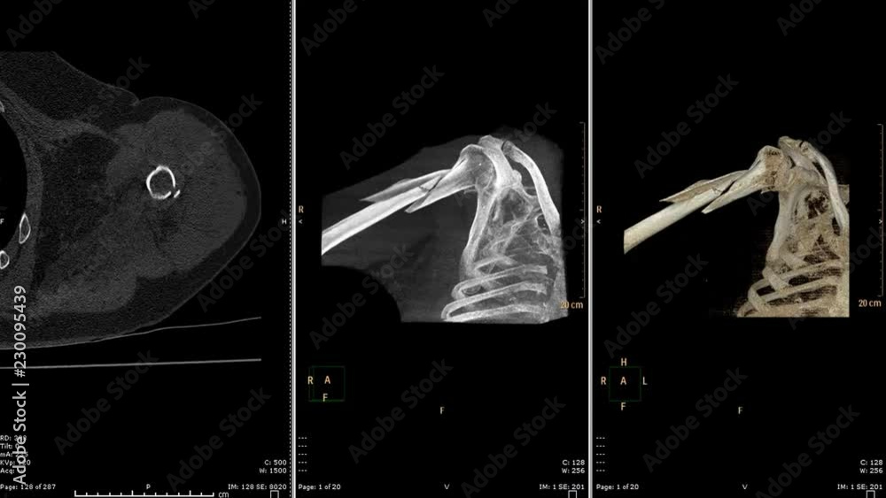 Poster ct scan of fracture left humerus with shoulder axial view, mip , 3d rendering image.