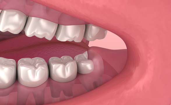 Wisdom tooth problem. Medically accurate tooth 3D animation
