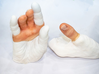 Amputation of the fingers. Hand with a model of fingers. Finger prosthesis. Prosthetics