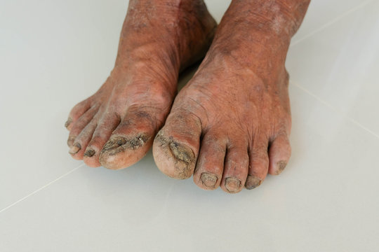 Diabetes foot and Side effects of the disease