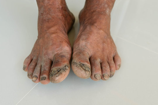 Diabetes foot and Side effects of the disease