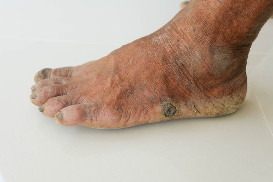 Diabetes foot and Side effects of the disease
