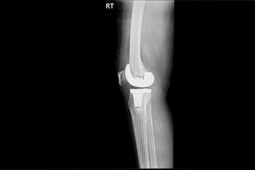 X-ray image of lateral and anteroposterior Right knee joint with total knee replacement.