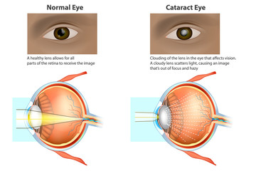 Сataract is a clouding of the lens. Medical illustration of a normal eye and an eye with a cataract, clouded lens - obrazy, fototapety, plakaty