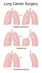 Illustration of lung cancer surgery