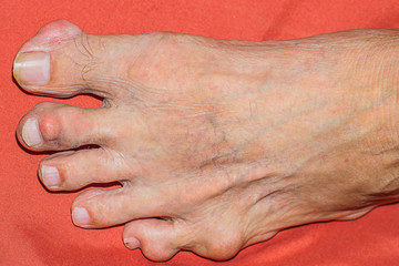 Severe gout in men suffering from joint pain, bone pain, gout, rheumatoid symptoms, radioactive sickness, ill man concept of male osteoporosis, injured bone, injury, pain, arthritis,arm, foot, knee