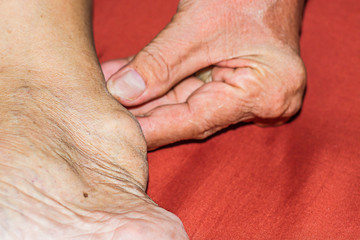 Severe gout in men suffering from joint pain, bone pain, gout, rheumatoid symptoms, radioactive sickness, ill man concept of male osteoporosis, injured bone, injury, pain, arthritis,arm, foot, knee