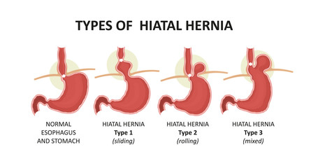 types of hiatal hernia - obrazy, fototapety, plakaty