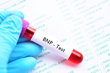 Blood sample for B-type natriuretic peptide or BNP test, cardiac marker for acute or chronic heart failure
