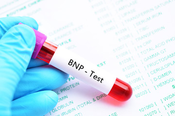 Obraz premium Blood sample for B-type natriuretic peptide or BNP test, cardiac marker for acute or chronic heart failure 