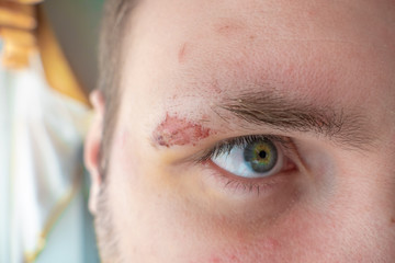 Suture wound on face of young man / Stitched up skin on face of young man after suture removal 