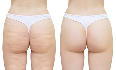 Cellulite on the buttocks and thighs. White isolate. Before and after - obrazy, fototapety, plakaty