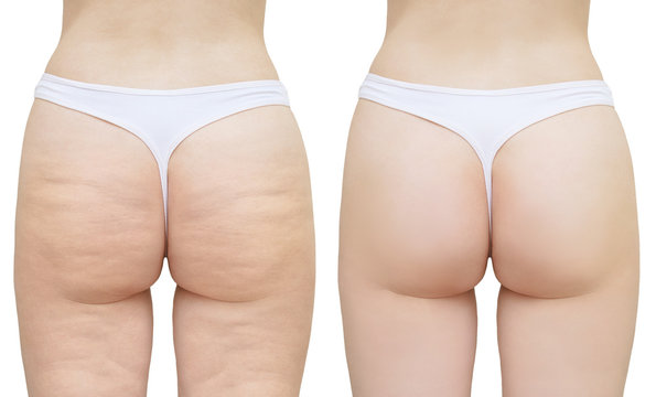 Cellulite on the buttocks and thighs. White isolate. Before and after
