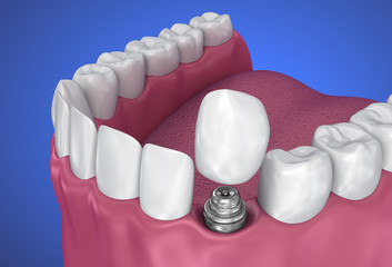 Crown installation other implantat. 3D illustration