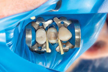 two chewing side teeth of the upper jaw after treatment of caries. Restoration of the chewing surface with a photopolymer filling material using the Rubber Dam system © Сергей Кучугурный