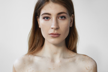 Headshot of gorgeous attractive young Caucasian female with natural make up and loose hair posing isolated with serious confident facial expression, having auto immune vitiligo skin condition