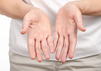 Female hands psoriasis on a white background. Isolation