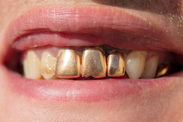 Golden teeth in the mouth of a man