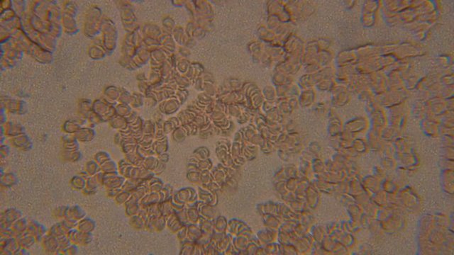 Blood, diseases, interstitial fluid, bacterial background, research using a microscope at extreme magnification of about.