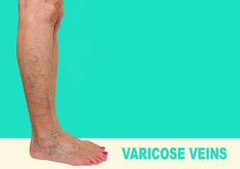 The varicose veins on female legs on green background