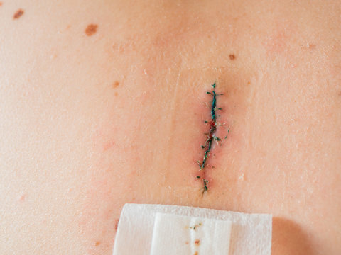 Close up photo of scar after removal of surgical sutures. Large nevus has been excised surgically with a scalpel. Preventive measure against skin cancer.