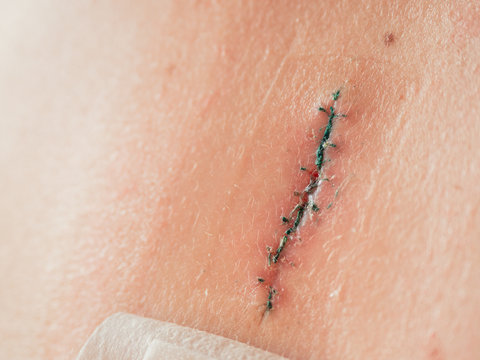 Close up photo of scar after removal of surgical sutures. Large nevus has been excised surgically with a scalpel. Preventive measure against skin cancer.