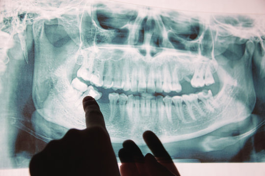 Panoramic x-ray image of teeth. Some teeth removed, problem with teeth