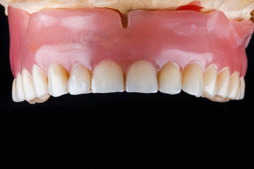 temporary prosthesis maxilla polymer
