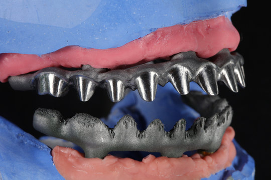 Titanium Dental beams on the model, with treatment and without it