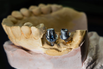 Titanium abutments and a frame made of metal KHS, a side view of the model