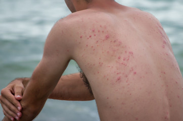 White and red pimples and acne on the man's back.